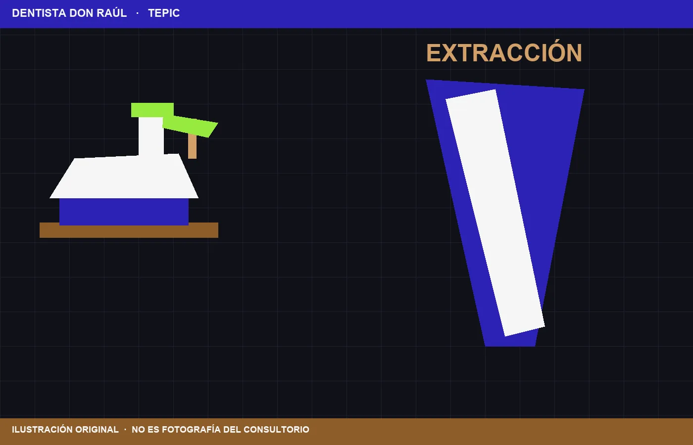 Ilustración de Extracción simple. No es fotografía clínica.