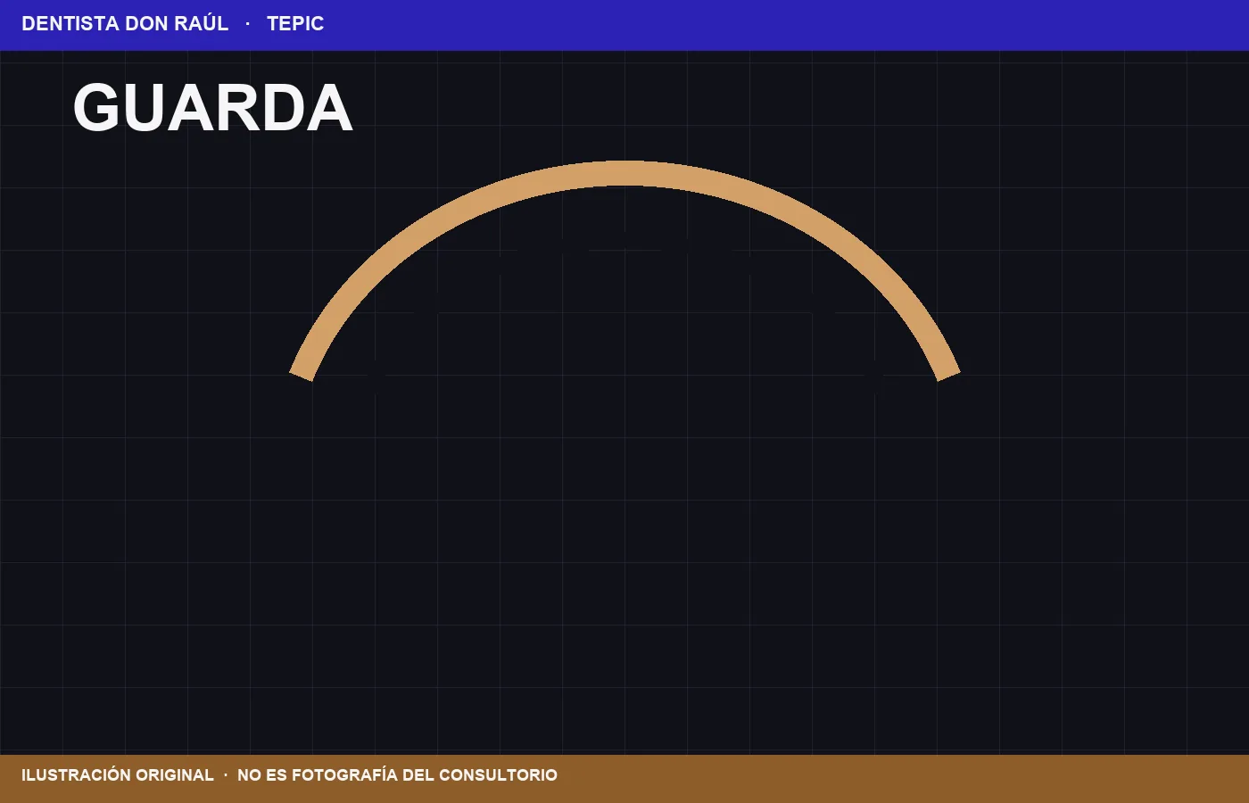 Ilustración de Guardaférrula. No es fotografía clínica.